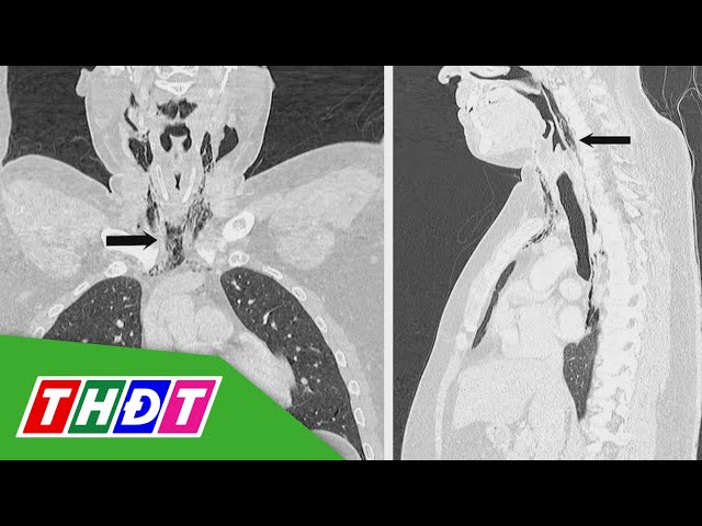 Ghi nhận trường hợp "rách khí quản vì nhịn hắt hơi" đầu tiên trên thế giới | THDT