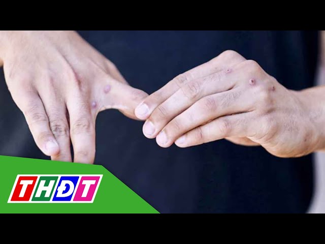 Bệnh đậu mùa khỉ lây lan nhanh, 6 người tử vong | THDT