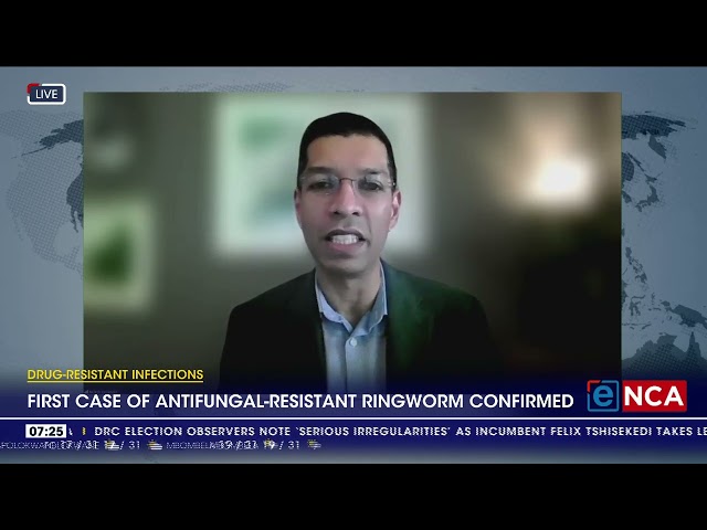 First case of antifungal-resistant ringworm confirmed