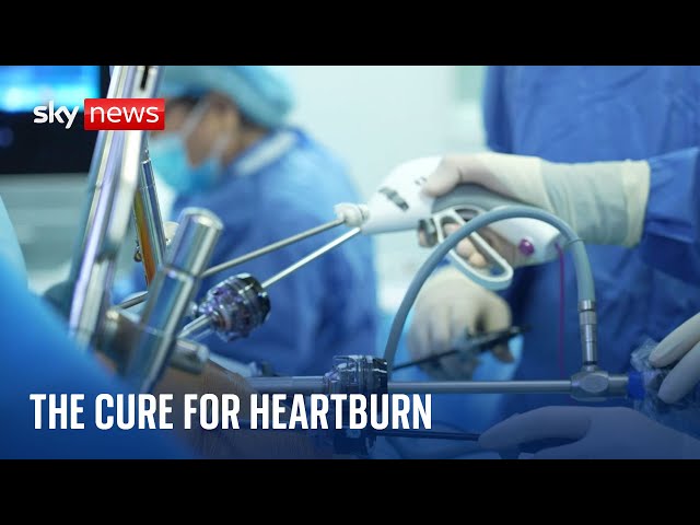 Heartburn: 'Revolutionary' surgical procedure cures condition with a device