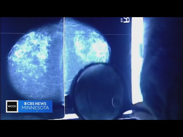 Researchers look to AI to help breast cancer patients