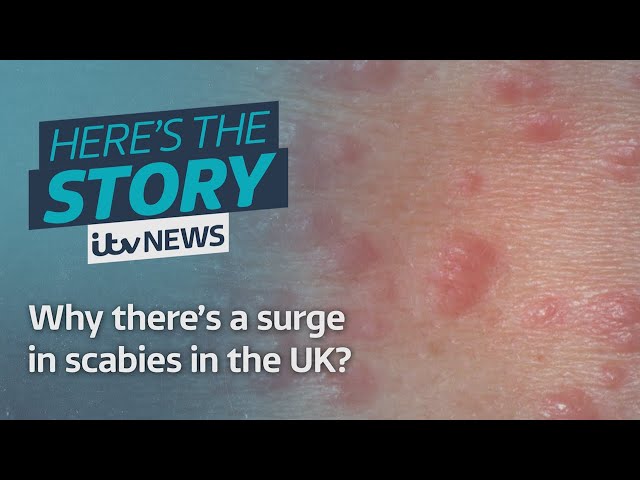 Why there’s a surge in scabies in the UK? | ITV News