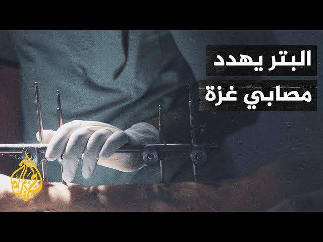 أصوات من غزة| أطباء يحذرون من نفاد مادة البلاتين الخاصة بتثبيت الكسور