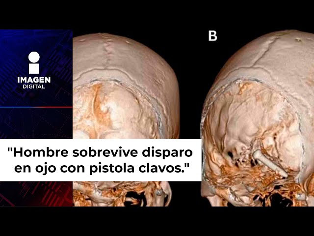 Hombre sobrevive tras dispararse en un ojo con una pistola de clavos averiada