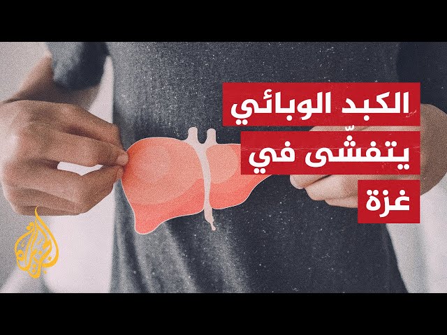 رسميا.. التهاب الكبد الوبائي A ينتشر في قطاع غزة