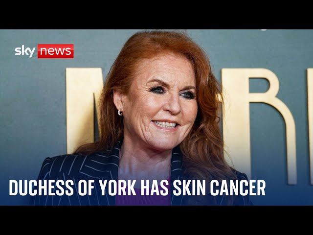 The Duchess of York Sarah Ferguson is receiving treatment for skin cancer