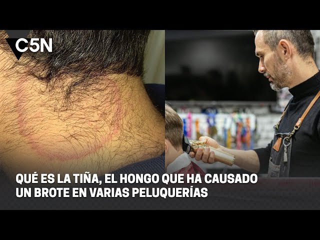 ALERTA por un BROTE de TIÑA en PELUQUERÍAS: QUÉ ES, SÍNTOMAS y cómo ELIMINARLA