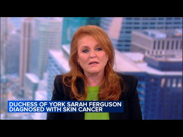 Sarah Ferguson, Duchess of York, diagnosed with malignant melanoma