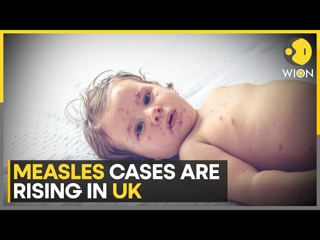 UK Measles Outbreak: Health officials urge parents to book children for vaccinations