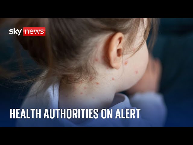 Measles: UK health authorities on alert after 'alarming rise' in cases across Europe