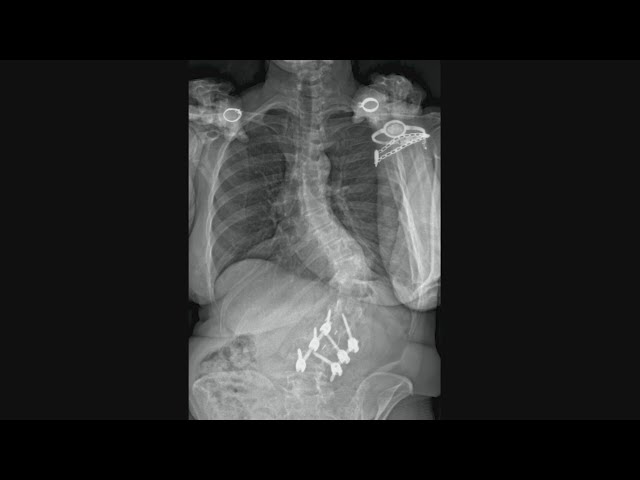 Colorado woman bedridden with severe scoliosis gets life back after spinal surgery