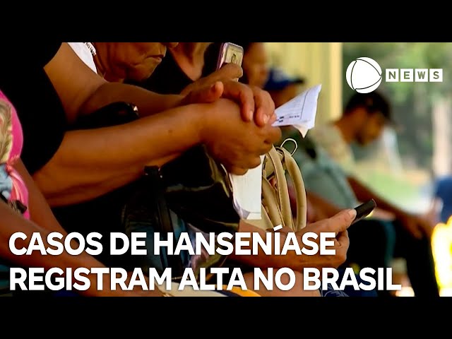 Casos de hanseníase registram alta no Brasil