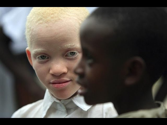 LIVE:  U HEALTH CHAT: HEALTH CONCERNS IN PERSONS WITH ALBINISM I  FEBRUARY 8, 2024