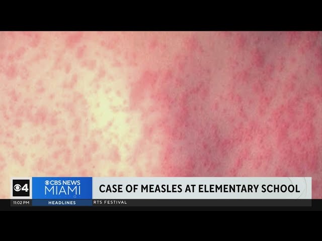 Case of measles detected at Broward elementary school