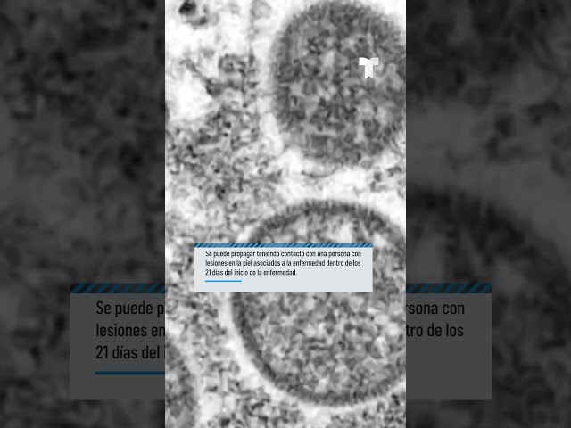 Viruela símica: conoce qué es y los síntomas