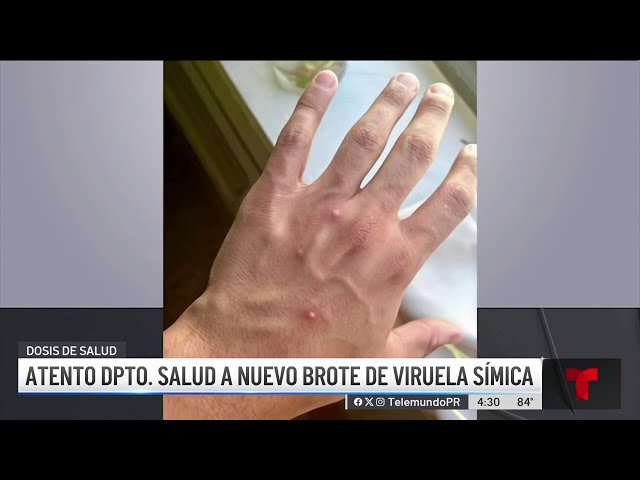 Atentos en Salud por nuevo brote de la viruela símica