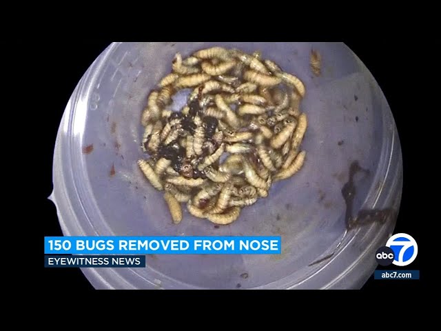 150 bugs removed from Florida man's nose