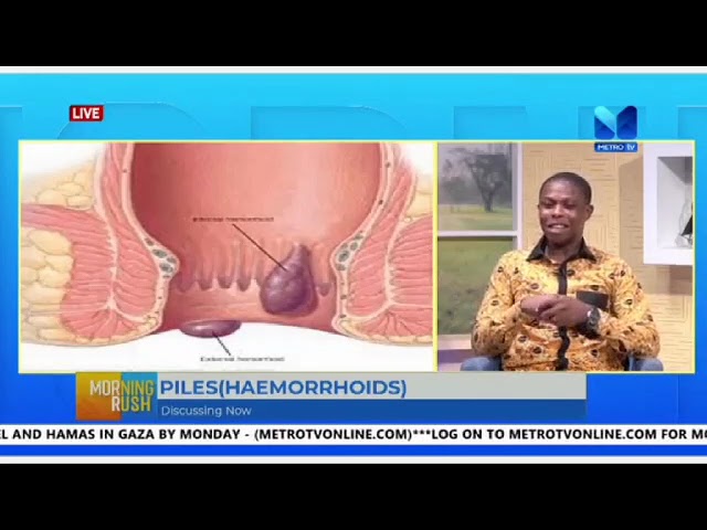 A Discussion on Piles (HAEMORRHOIDS) @Metro Tv Ghana