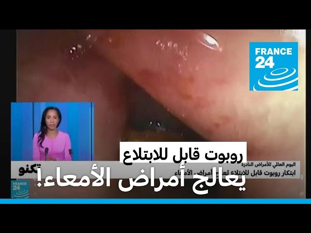 ⁣اليوم العالمي للأمراض النادرة: روبوت قابل للابتلاع يعالج مشاكل انتفاخ البطن والإمساك والغثيان!