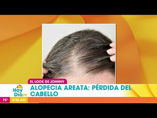 El look de Johnny: Qué es la alopecia