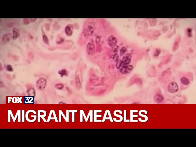 Chicago migrant diagnosed with measles; city's first case since 2019