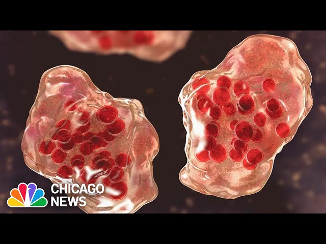 Measles cases confirmed in Chicago for the first time since 2019