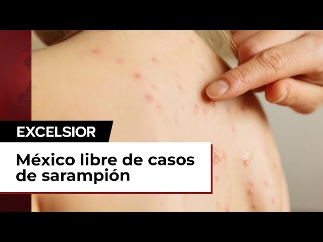 México libre de casos de sarampión