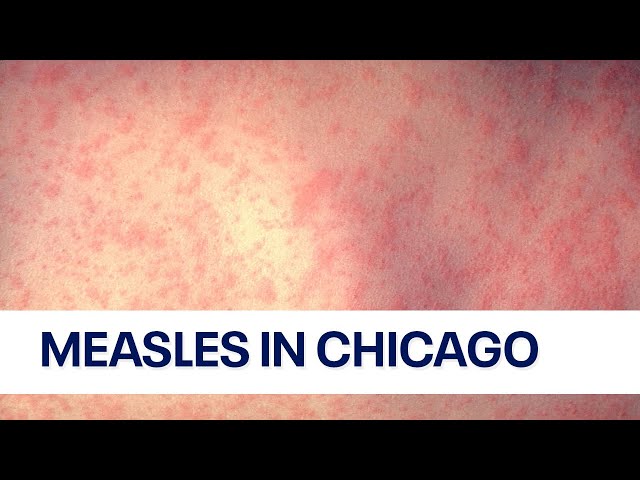 Another migrant child at Pilsen shelter diagnosed with measles