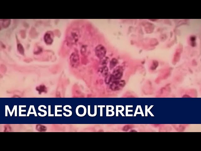 7 measles cases reported at Pilsen migrant shelter