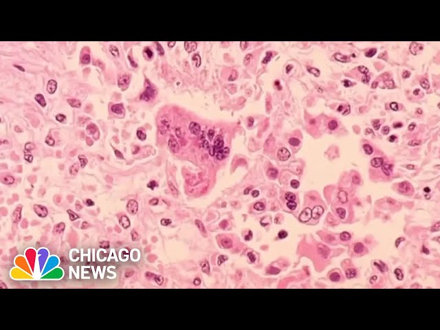 Chicago's MEASLES cases rise to 8