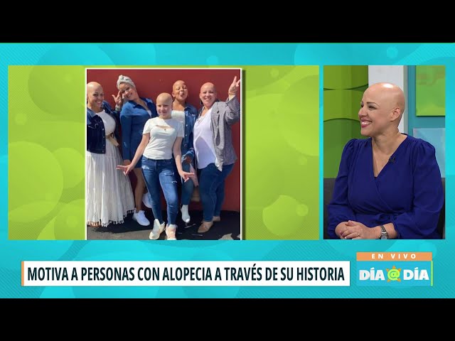 Mujer abraza la Alopecia y crea fundación para brindar apoyo a personas que la padecen