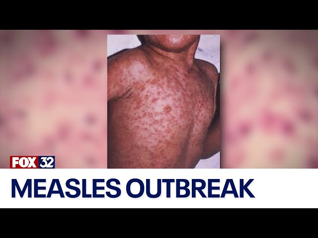 Chicago health officials mobilize to contain measles outbreak