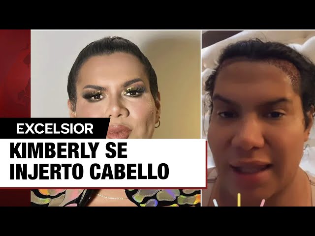 Kimberly, La Más Preciosa se pone injerto de cabello; la critican en redes