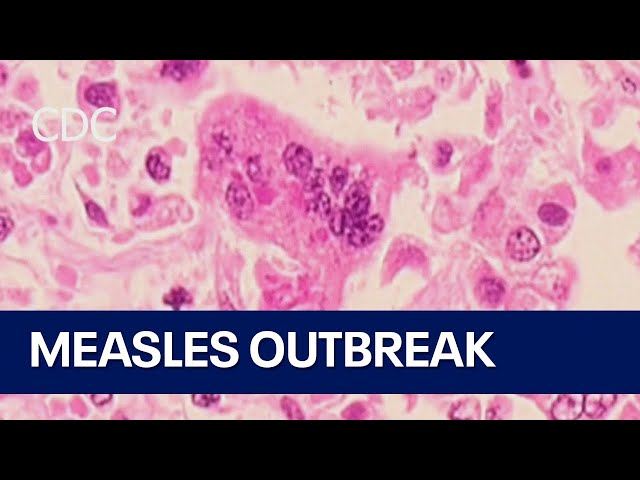 Measles cases on the rise across the U.S.