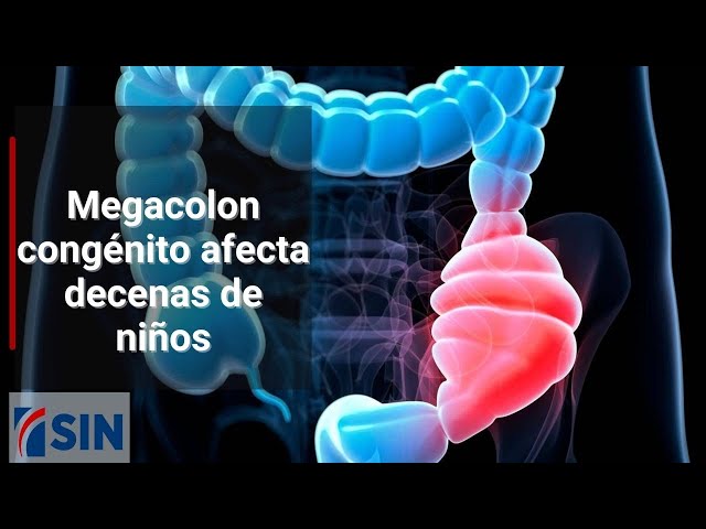 Megacolon congénito afecta decenas de niños