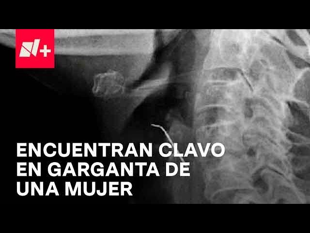 Cirujanos en Perú, salvan la vida de una mujer que tragó un clavo - Despierta