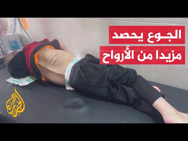 وفاة الطفل محمد النجار في مشفى كمال عدوان بسبب سوء التغذية ونقص العلاج