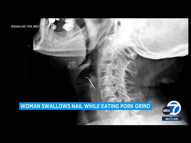 Woman accidentally swallows nail hidden inside pork grinds in Peru