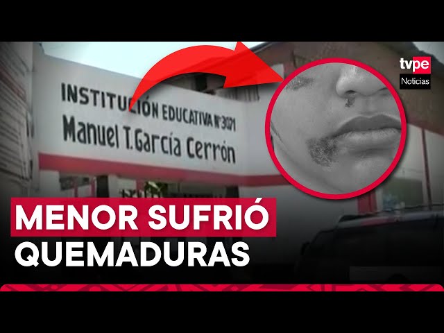 Puente Piedra: niña sufrió quemaduras en el rostro dentro de su colegio