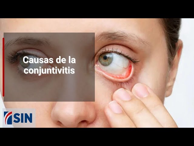 ⁣Causas de la conjuntivitis