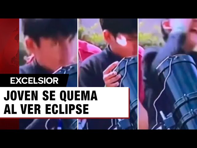 ⁣Joven experimenta inesperado incidente durante eclipse solar total... 'se quema' con teles