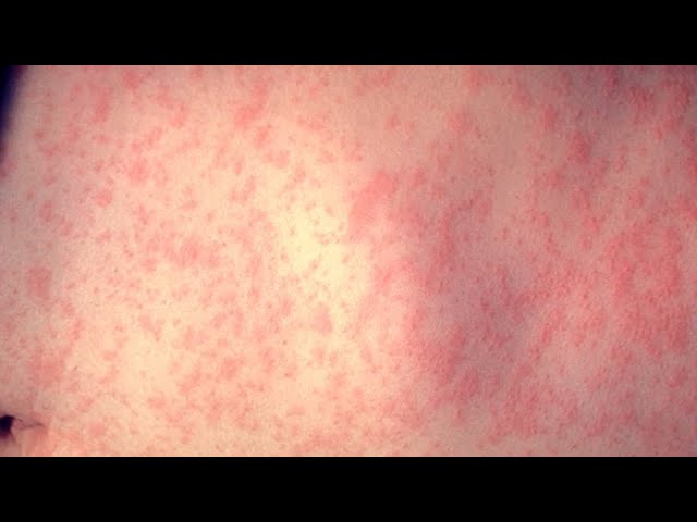 ⁣Measles case confirmed in visitor who traveled through LA County, health officials say