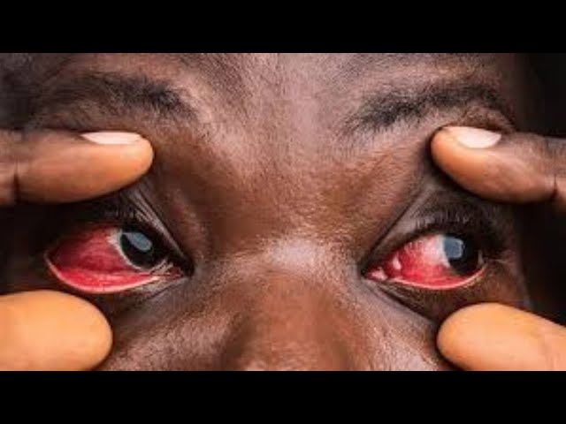 ⁣Kagadi authorities concerned as Red Eye crisis spreads further
