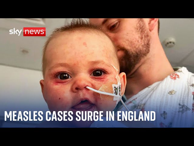 ⁣England facing a measles emergency as cases surge
