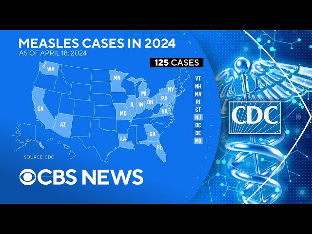 ⁣Number of U.S. measles cases continues to rise
