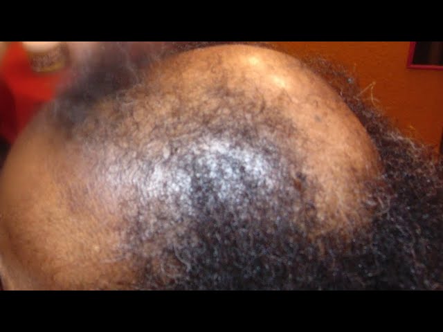 ⁣Health experts explain reason behind hair loss | Health Focus