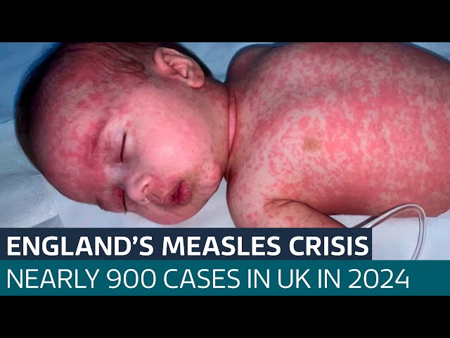 Parents of baby who almost died after contracting measles warn others to get immunised | ITV News