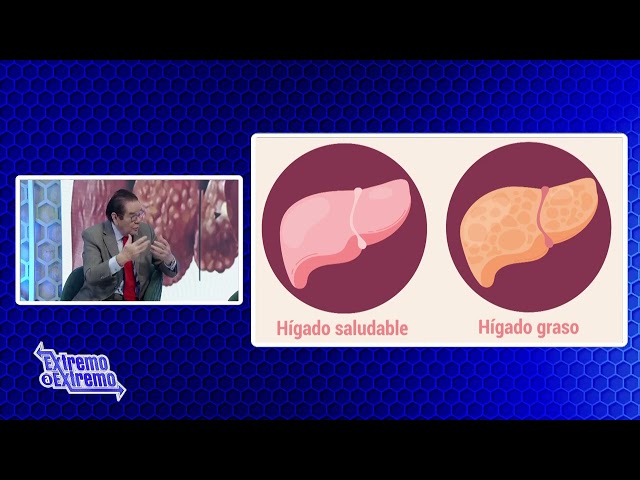 ⁣Dr. Gautreau con el tema: Hígado Graso/Enfermedad hepática más común | Extremo a Extremo