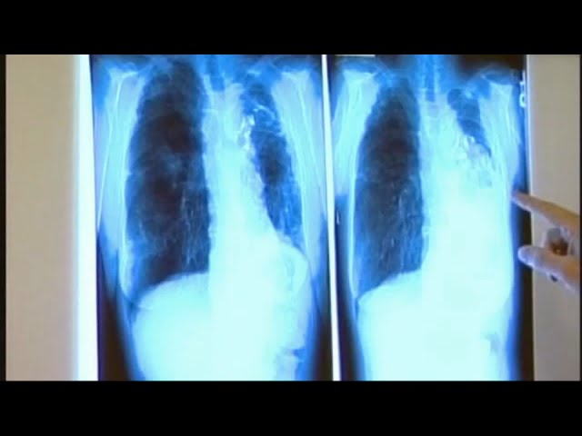 ⁣Long Beach tuberculosis outbreak: 1 killed, 14 infected, 170 exposed