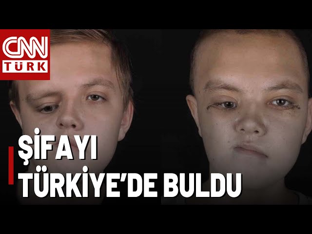 ⁣Yüz Gelişim Bozukluğu Olan Kazakistanlı Nikita İstanbul'da Ameliyat Oldu